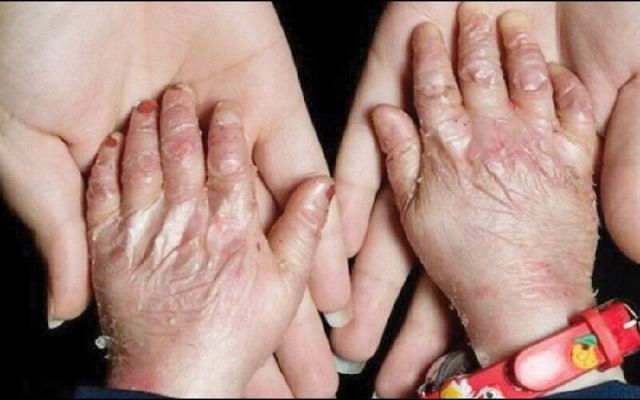 بیماری‌های نادر مشمول بیمه رایگان