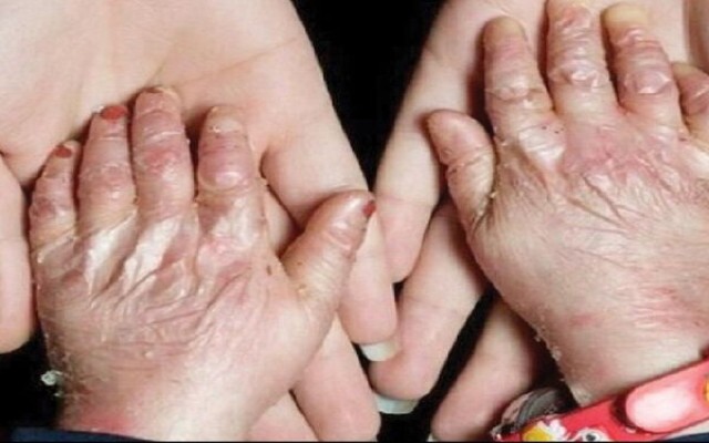 شناسایی ۴۲۲ بیماری نادر در ایران/پوشش ویژه ۳۱۷ بیماری در «صندوق خاص و صعب‌العلاج»